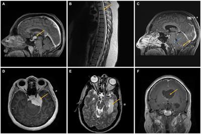 Diagnostic challenges of neurosarcoidosis in non-endemic areas